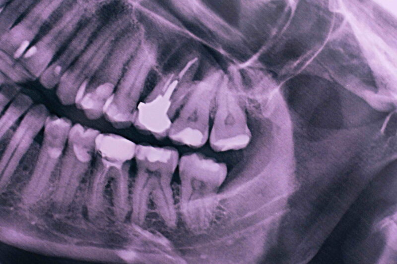 Guide to Wisdom Teeth Removal: What to Expect Before, During, and After Surgery