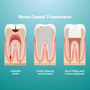 Root canal treatment