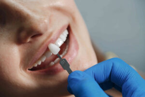 Dental Veneers