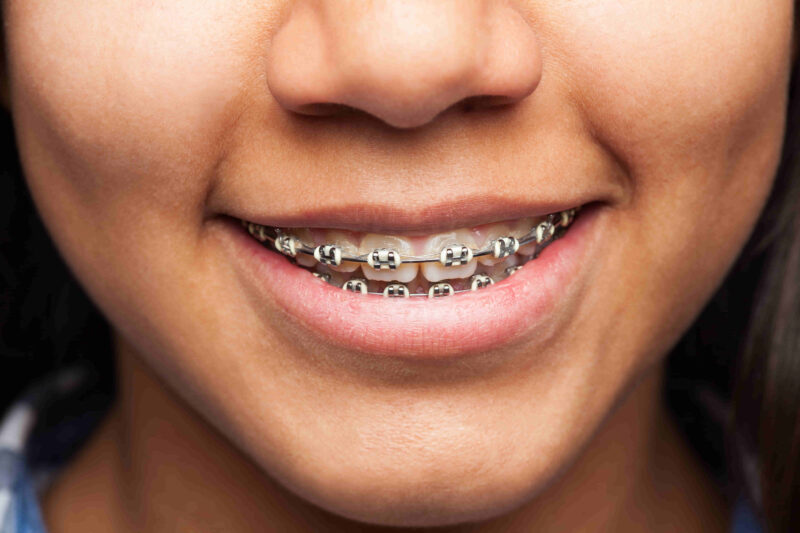 The Comprehensive Guide to Different Types of Orthodontic Treatments